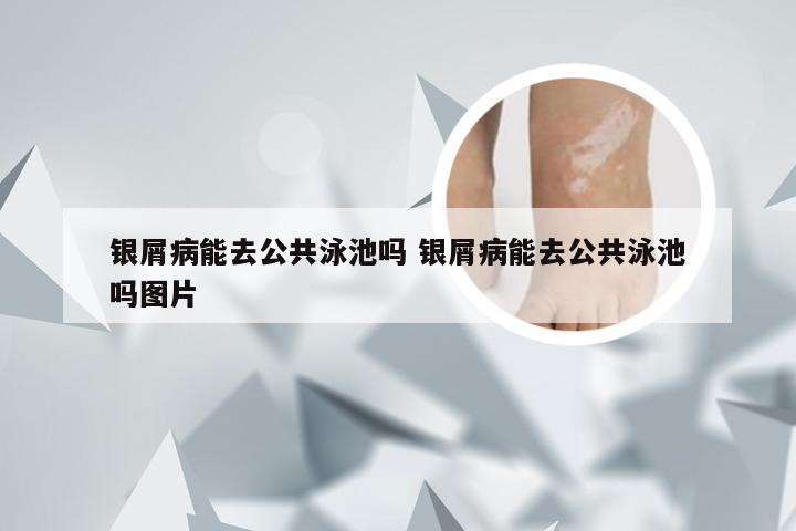 银屑病能去公共泳池吗 银屑病能去公共泳池吗图片