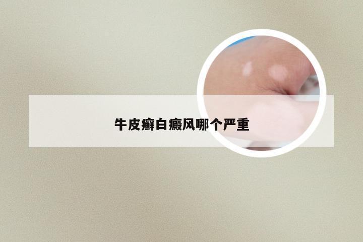 牛皮癣白癜风哪个严重