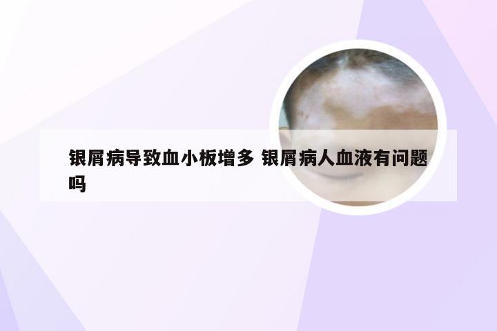 银屑病导致血小板增多 银屑病人血液有问题吗
