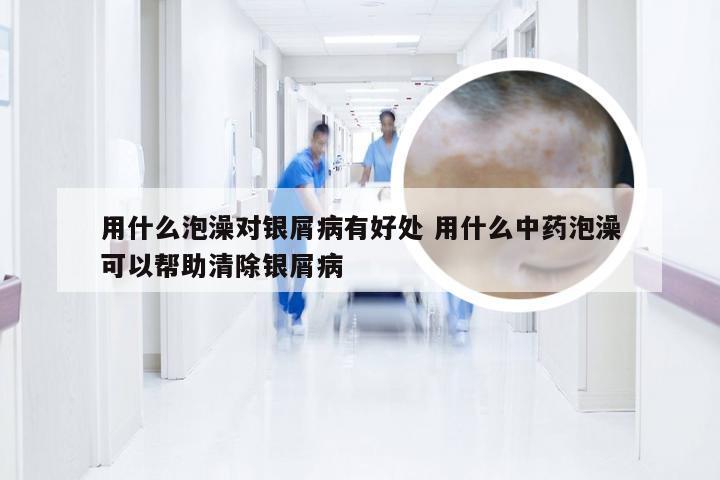 用什么泡澡对银屑病有好处 用什么中药泡澡可以帮助清除银屑病
