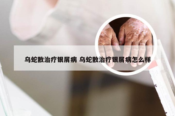 乌蛇散治疗银屑病 乌蛇散治疗银屑病怎么样