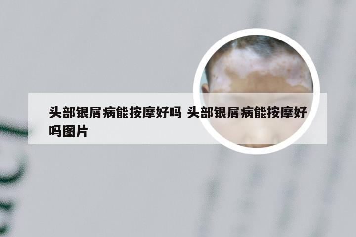 头部银屑病能按摩好吗 头部银屑病能按摩好吗图片