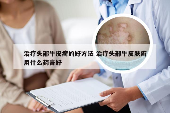 治疗头部牛皮癣的好方法 治疗头部牛皮肤癣用什么药膏好