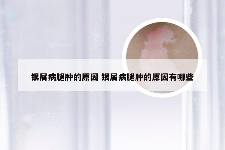 银屑病腿肿的原因 银屑病腿肿的原因有哪些
