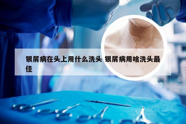 银屑病在头上用什么洗头 银屑病用啥洗头最佳