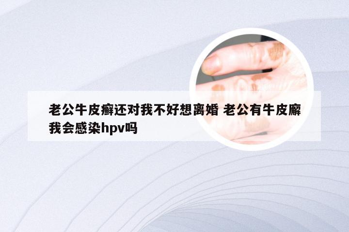 老公牛皮癣还对我不好想离婚 老公有牛皮廨我会感染hpv吗