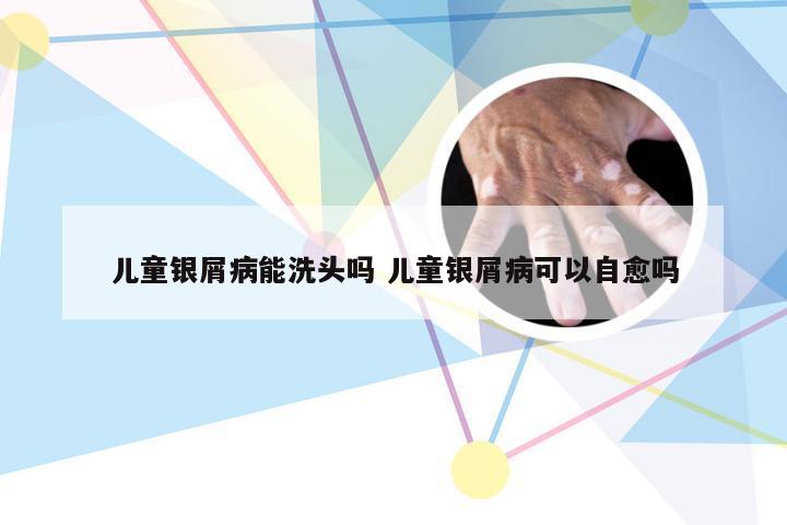 儿童银屑病能洗头吗 儿童银屑病可以自愈吗