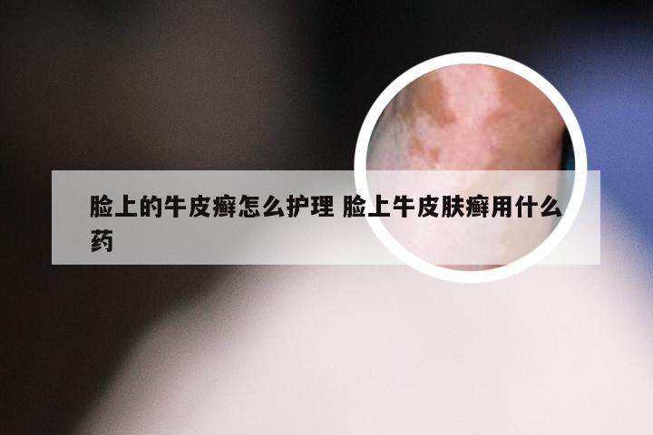 脸上的牛皮癣怎么护理 脸上牛皮肤癣用什么药
