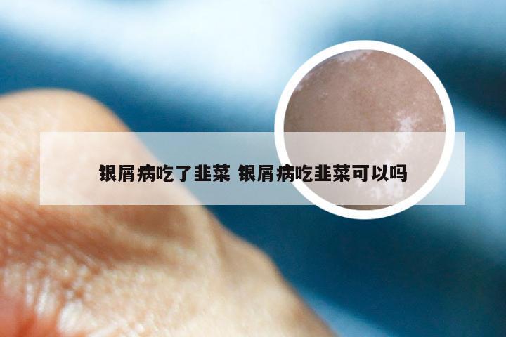 银屑病吃了韭菜 银屑病吃韭菜可以吗