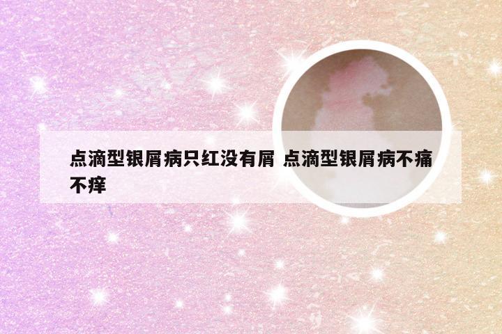 点滴型银屑病只红没有屑 点滴型银屑病不痛不痒