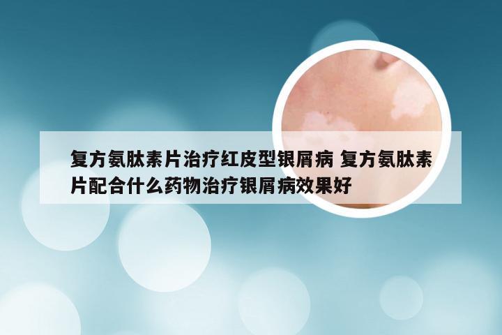 复方氨肽素片治疗红皮型银屑病 复方氨肽素片配合什么药物治疗银屑病效果好