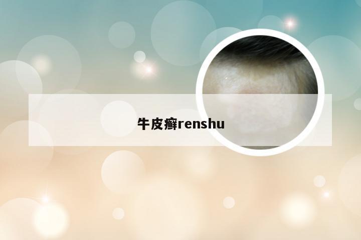 牛皮癣renshu