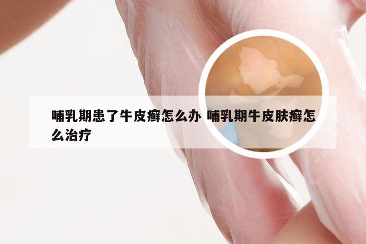 哺乳期患了牛皮癣怎么办 哺乳期牛皮肤癣怎么治疗