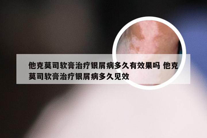 他克莫司软膏治疗银屑病多久有效果吗 他克莫司软膏治疗银屑病多久见效
