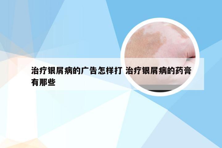 治疗银屑病的广告怎样打 治疗银屑病的药膏有那些