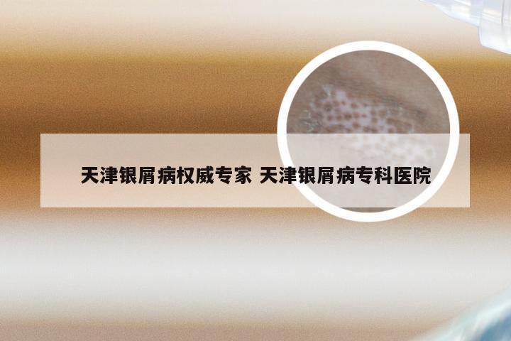 天津银屑病权威专家 天津银屑病专科医院