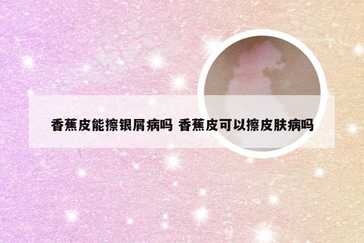 香蕉皮能擦银屑病吗 香蕉皮可以擦皮肤病吗