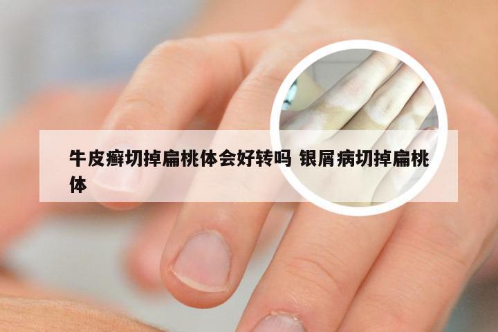 牛皮癣切掉扁桃体会好转吗 银屑病切掉扁桃体