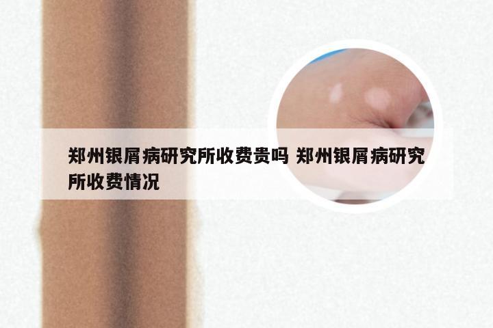 郑州银屑病研究所收费贵吗 郑州银屑病研究所收费情况
