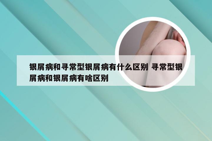 银屑病和寻常型银屑病有什么区别 寻常型银屑病和银屑病有啥区别