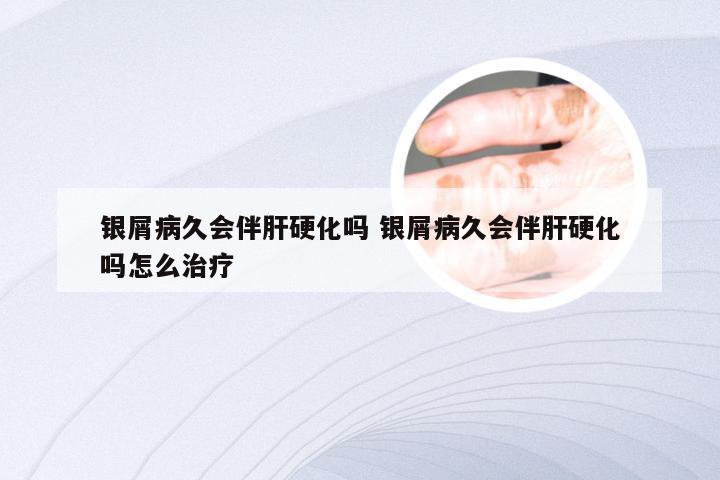 银屑病久会伴肝硬化吗 银屑病久会伴肝硬化吗怎么治疗