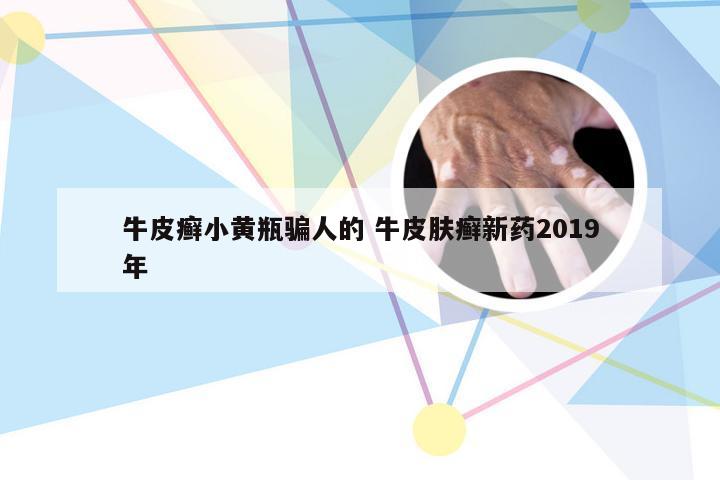 牛皮癣小黄瓶骗人的 牛皮肤癣新药2019年