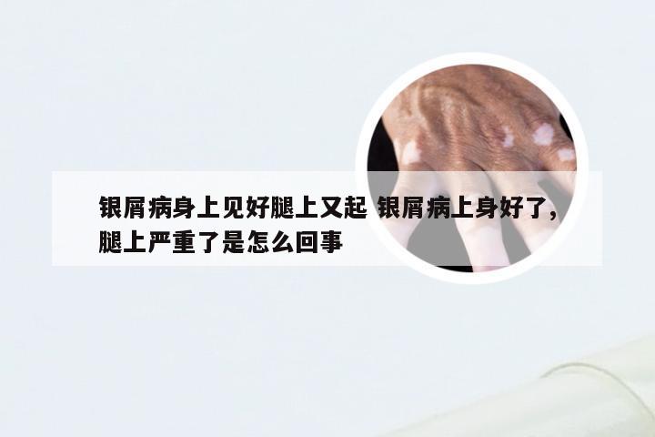 银屑病身上见好腿上又起 银屑病上身好了,腿上严重了是怎么回事