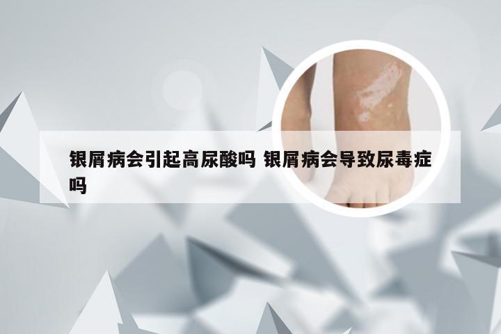银屑病会引起高尿酸吗 银屑病会导致尿毒症吗