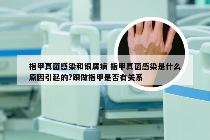 指甲真菌感染和银屑病 指甲真菌感染是什么原因引起的?跟做指甲是否有关系