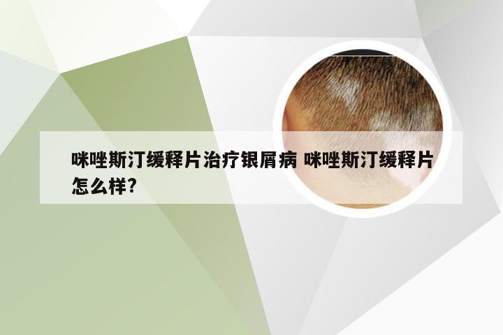 咪唑斯汀缓释片治疗银屑病 咪唑斯汀缓释片怎么样?