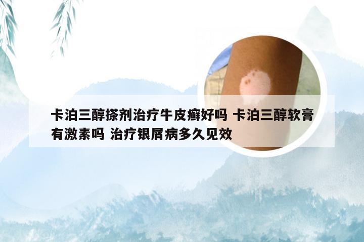 卡泊三醇搽剂治疗牛皮癣好吗 卡泊三醇软膏有激素吗 治疗银屑病多久见效