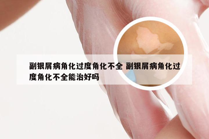 副银屑病角化过度角化不全 副银屑病角化过度角化不全能治好吗