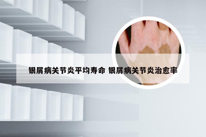 银屑病关节炎平均寿命 银屑病关节炎治愈率