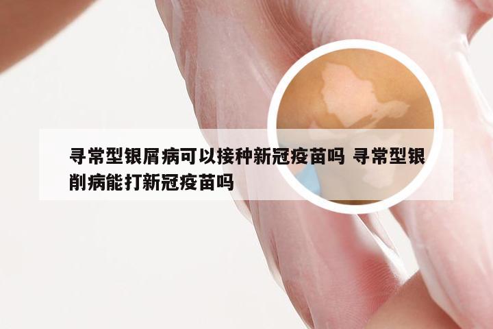 寻常型银屑病可以接种新冠疫苗吗 寻常型银削病能打新冠疫苗吗