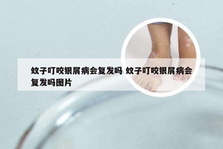 蚊子叮咬银屑病会复发吗 蚊子叮咬银屑病会复发吗图片
