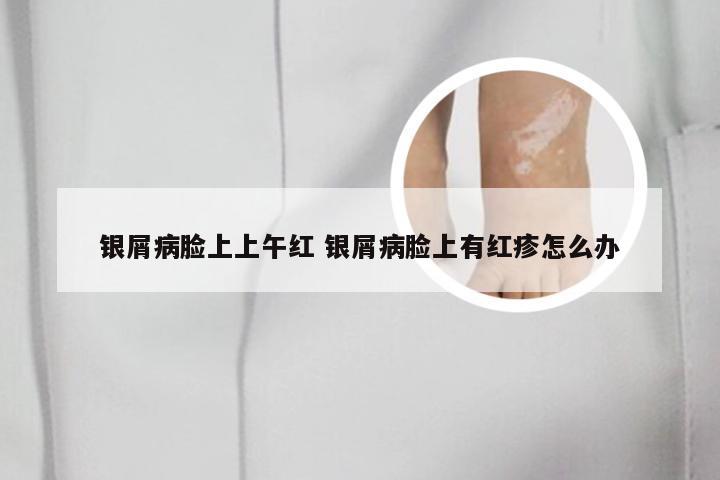 银屑病脸上上午红 银屑病脸上有红疹怎么办