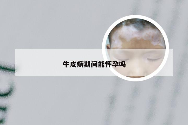 牛皮癣期间能怀孕吗