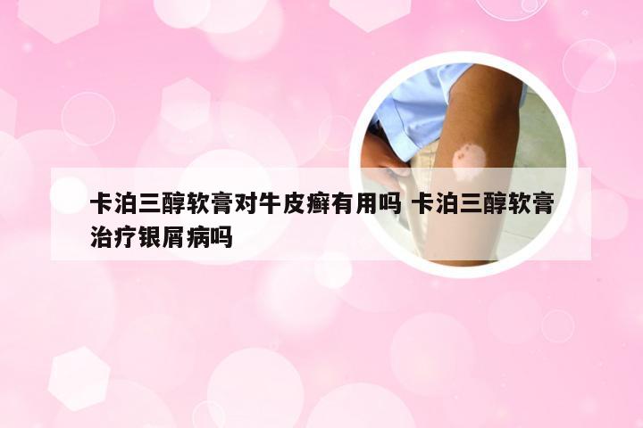 卡泊三醇软膏对牛皮癣有用吗 卡泊三醇软膏治疗银屑病吗