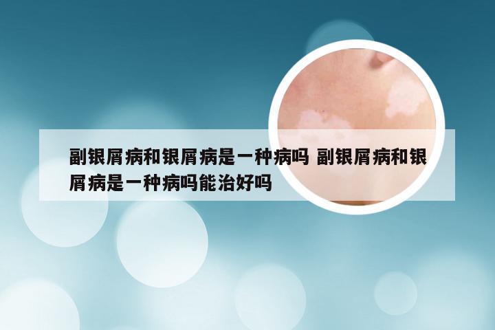 副银屑病和银屑病是一种病吗 副银屑病和银屑病是一种病吗能治好吗