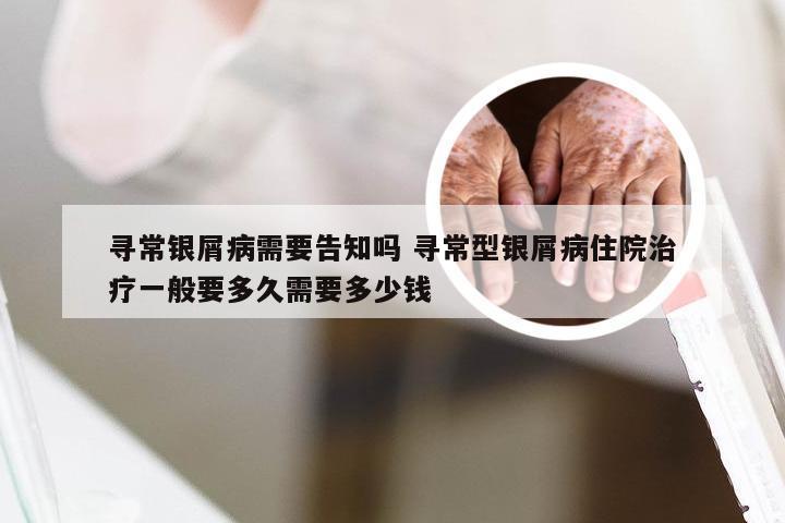 寻常银屑病需要告知吗 寻常型银屑病住院治疗一般要多久需要多少钱