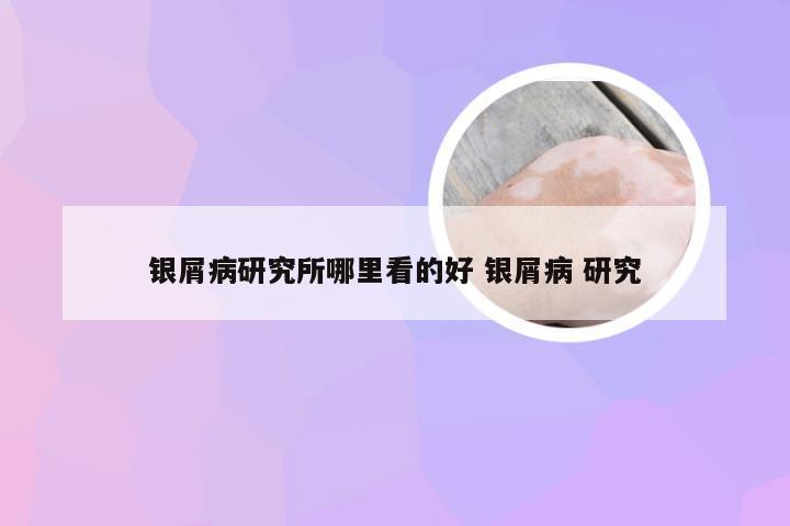 银屑病研究所哪里看的好 银屑病 研究
