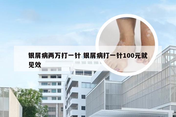 银屑病两万打一针 银屑病打一针100元就见效