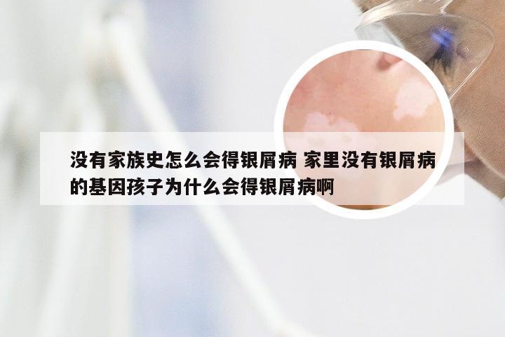 没有家族史怎么会得银屑病 家里没有银屑病的基因孩子为什么会得银屑病啊