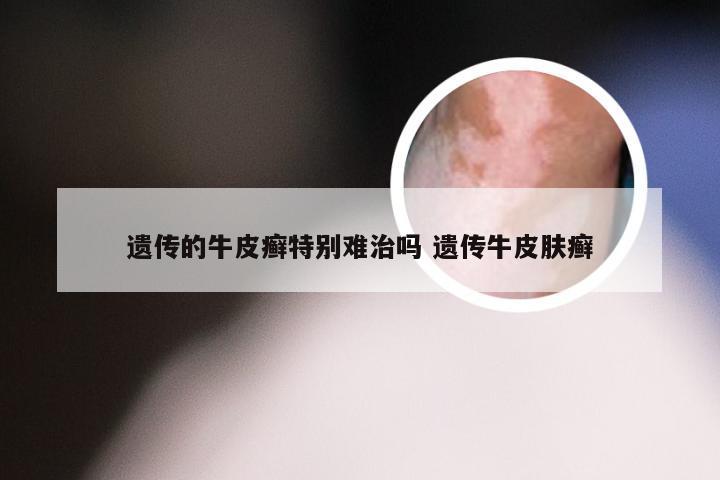 遗传的牛皮癣特别难治吗 遗传牛皮肤癣