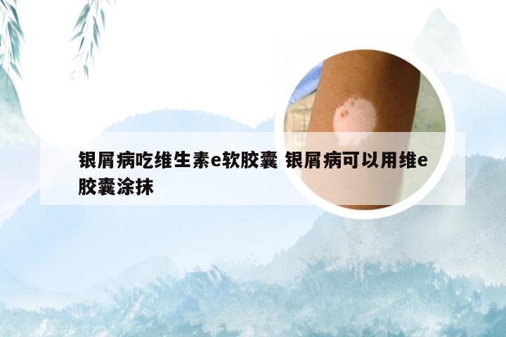 银屑病吃维生素e软胶囊 银屑病可以用维e胶囊涂抹