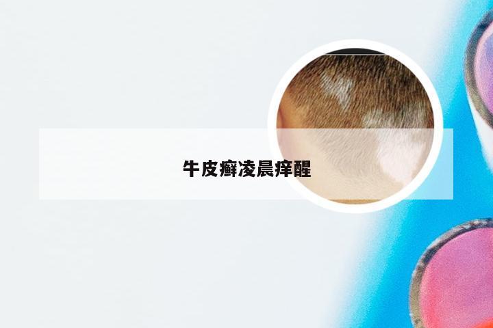 牛皮癣凌晨痒醒