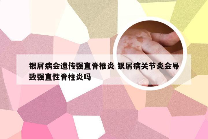 银屑病会遗传强直脊椎炎 银屑病关节炎会导致强直性脊柱炎吗