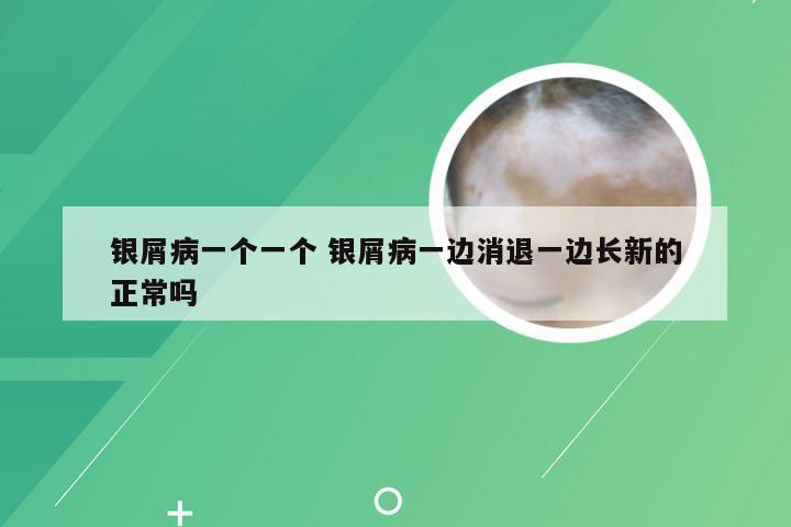 银屑病一个一个 银屑病一边消退一边长新的正常吗