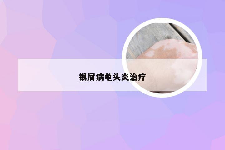 银屑病龟头炎治疗