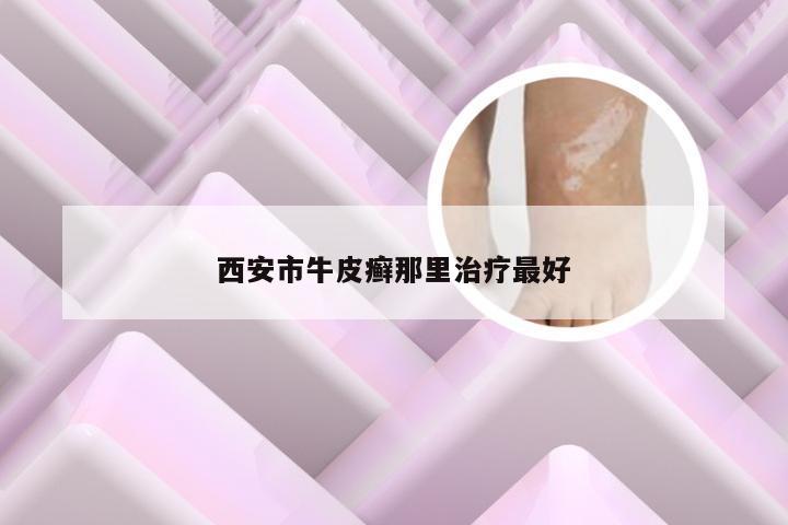 西安市牛皮癣那里治疗最好